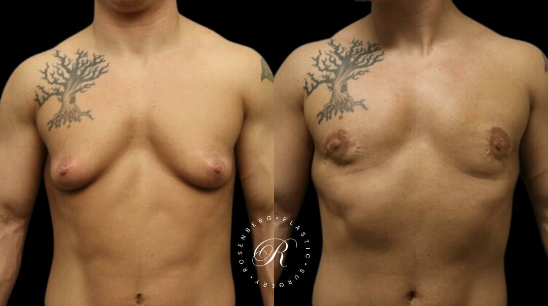 Top Surgery RPS Before & After.zip - 8