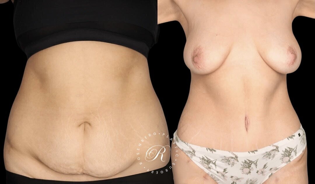 Abdominoplasty RPS Before & After.zip - 9