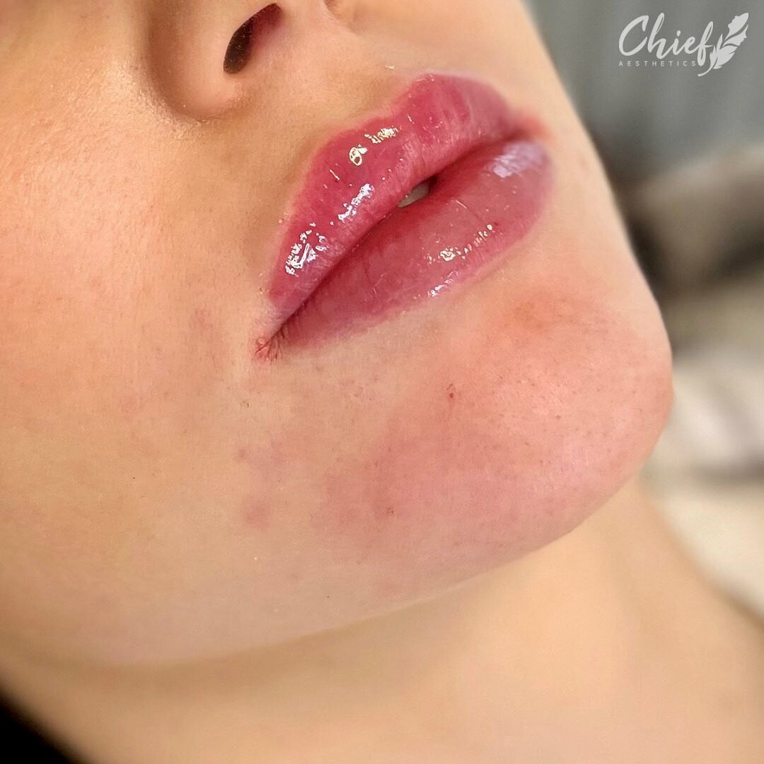 Lip-filler-buffalo-new-york-chief-aesthetics