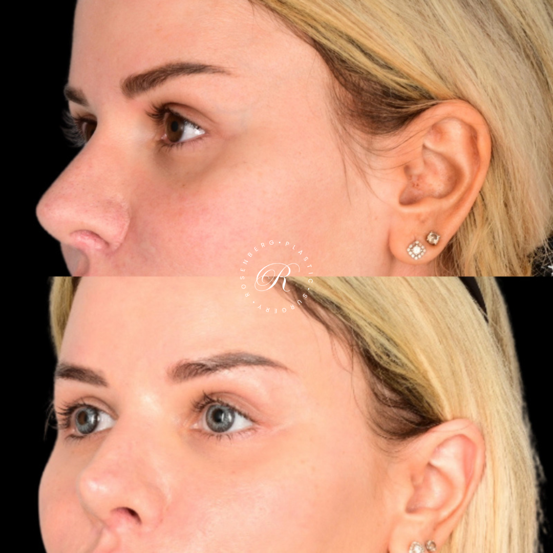 Blepharoplasty RPS Before & After.zip - 6