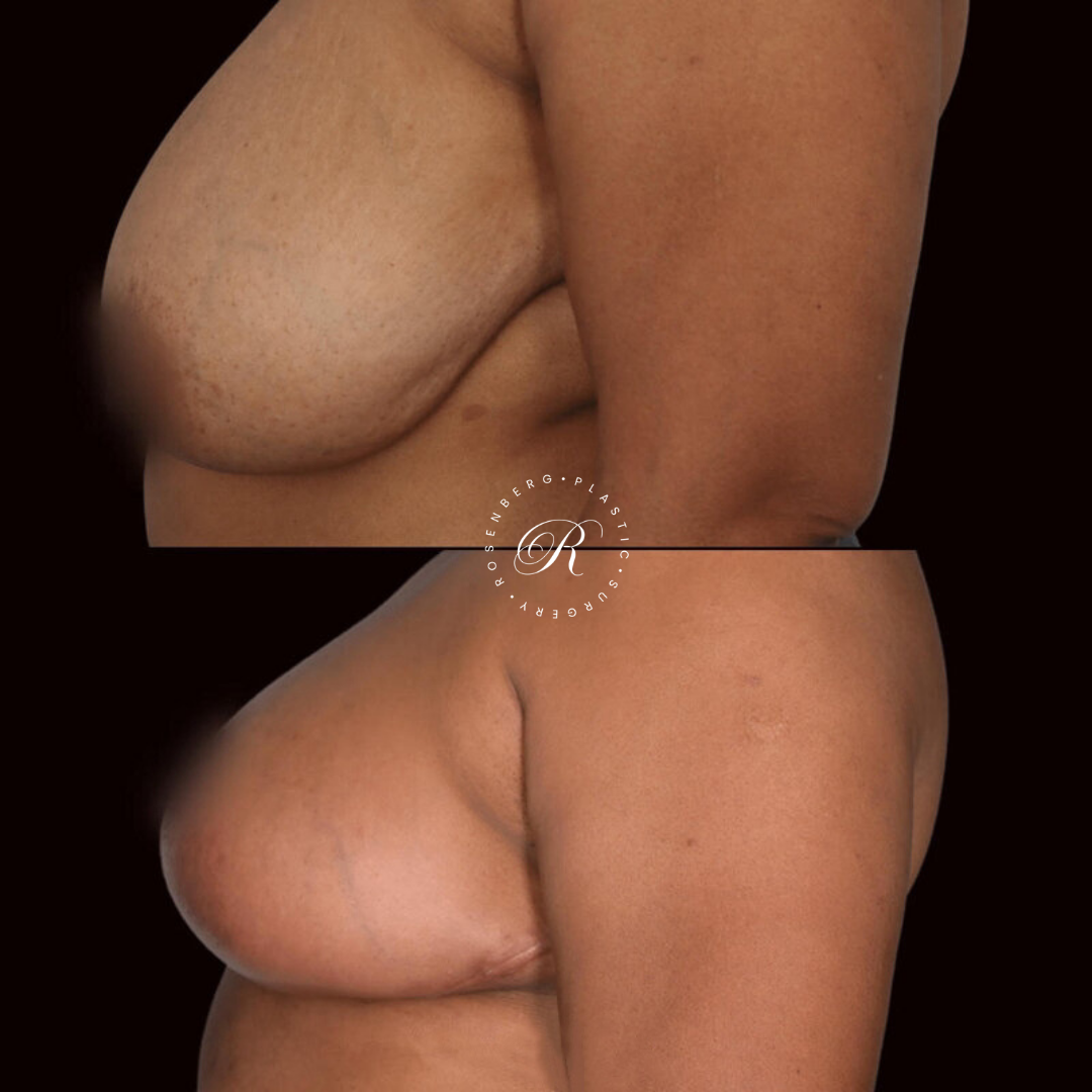Breast Lift & Reduction RPS Before & Afters.zip - 18