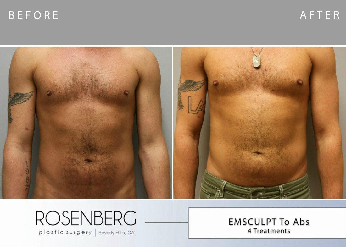 Emsculpt Results