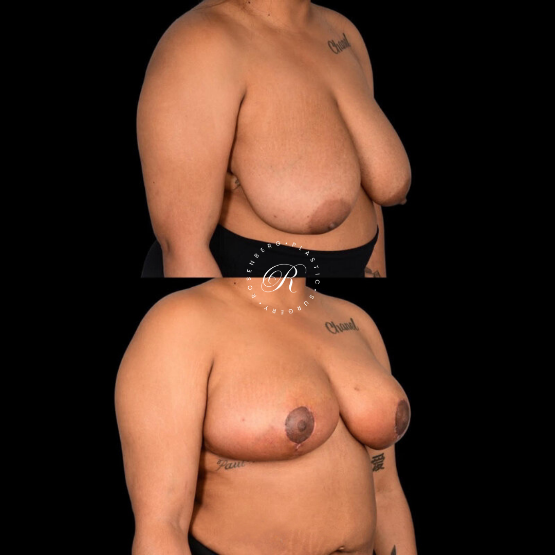 Breast Lift & Reduction RPS Before & Afters.zip - 75