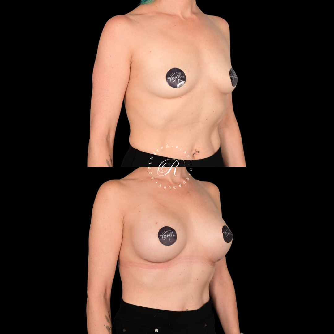 Breast Augmentation Before and After