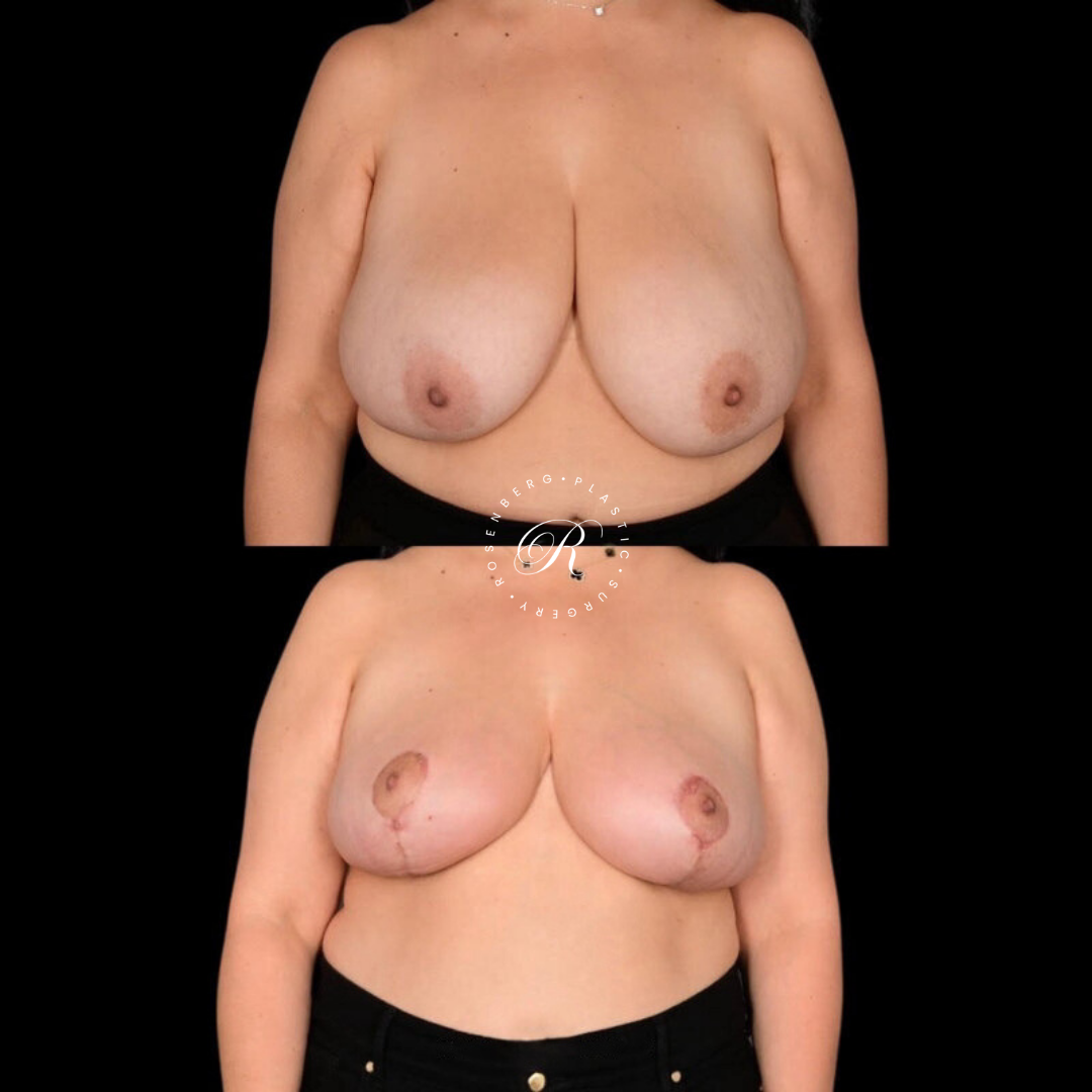Breast Lift & Reduction RPS Before & Afters.zip - 9