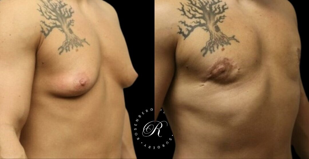 Top Surgery RPS Before & After.zip - 9