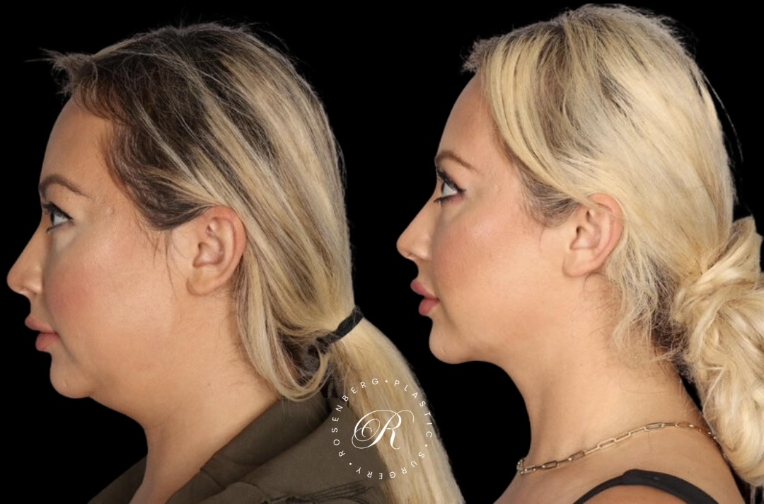 Neck Lipo RPS Before & After.zip - 13