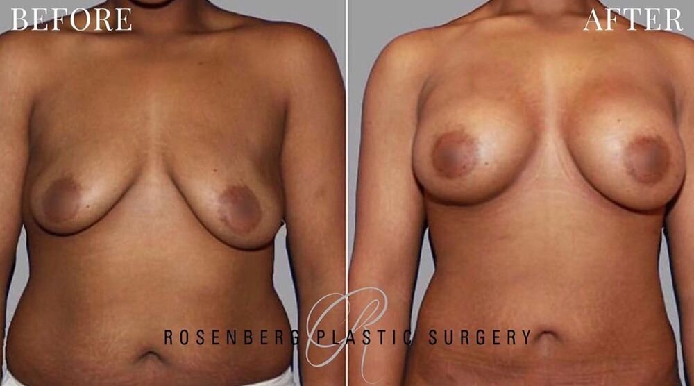 Breast Augmentation Results