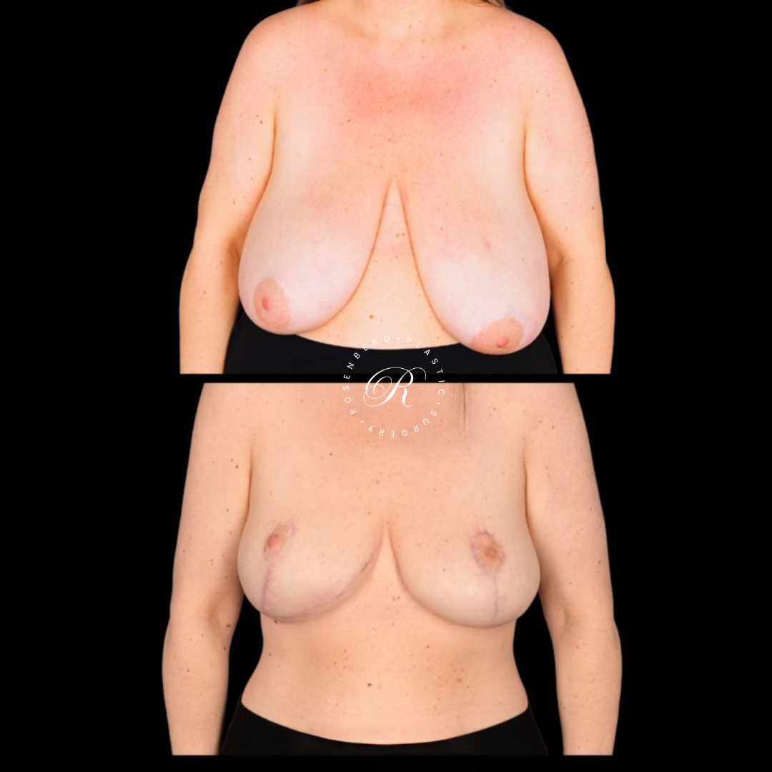 Breast Lift & Reduction RPS Before & Afters.zip - 55