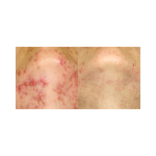 Rosacea and facial redness reduced after KTP laser treatment