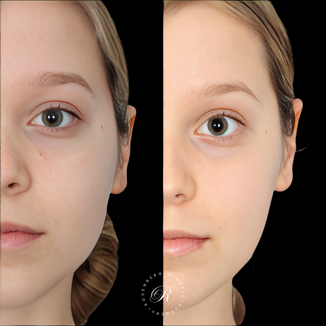 Mole Removal RPS Before & After.zip - 4