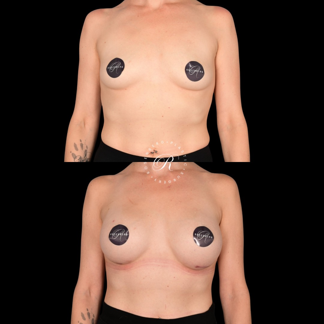 Breast Augmentation Before and After