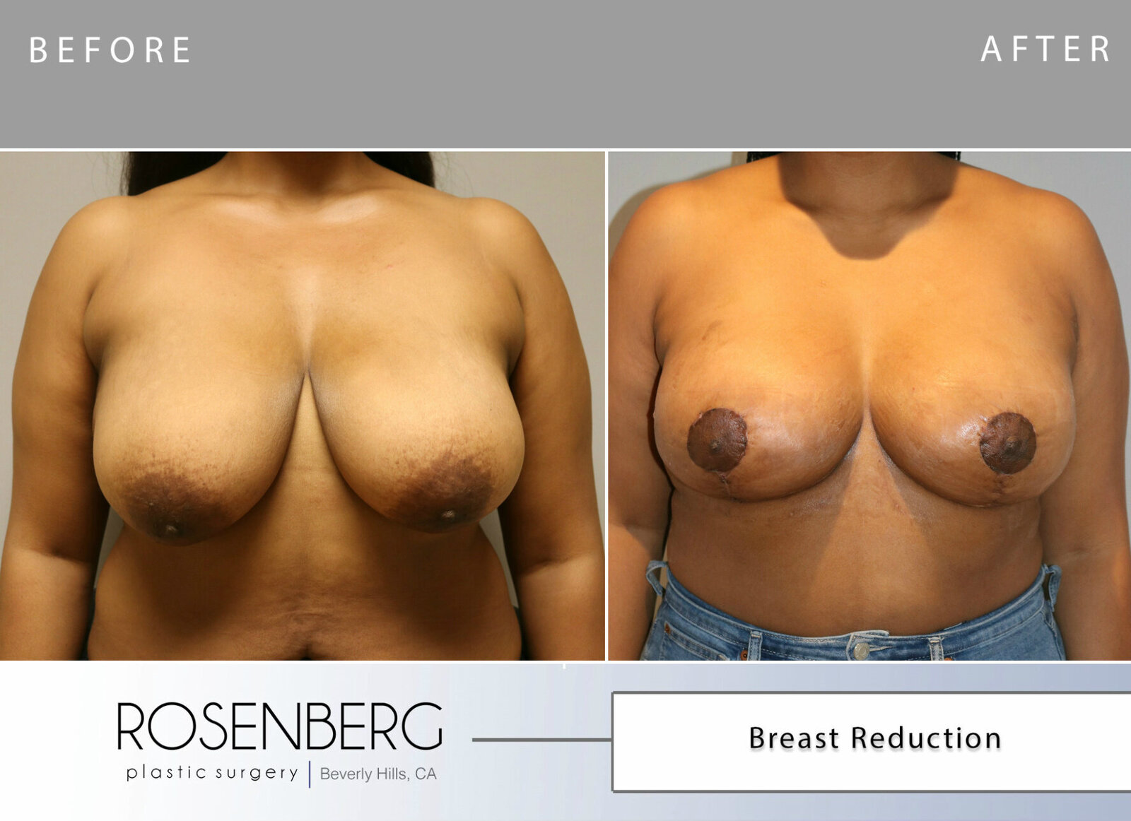 Germaine Breast Reduction Before 1