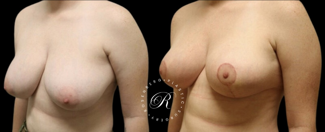 Breast Lift & Reduction RPS Before & Afters.zip - 97