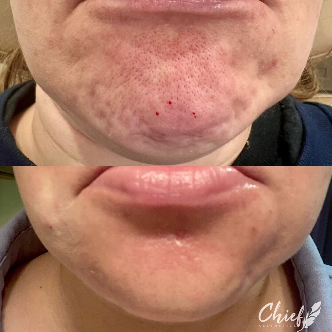 Chin-botox-chief-aesthetics-ny