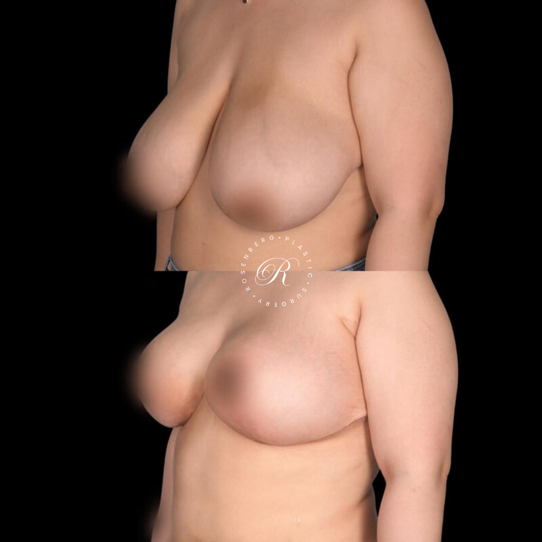 Breast Lift & Reduction RPS Before & Afters.zip - 62