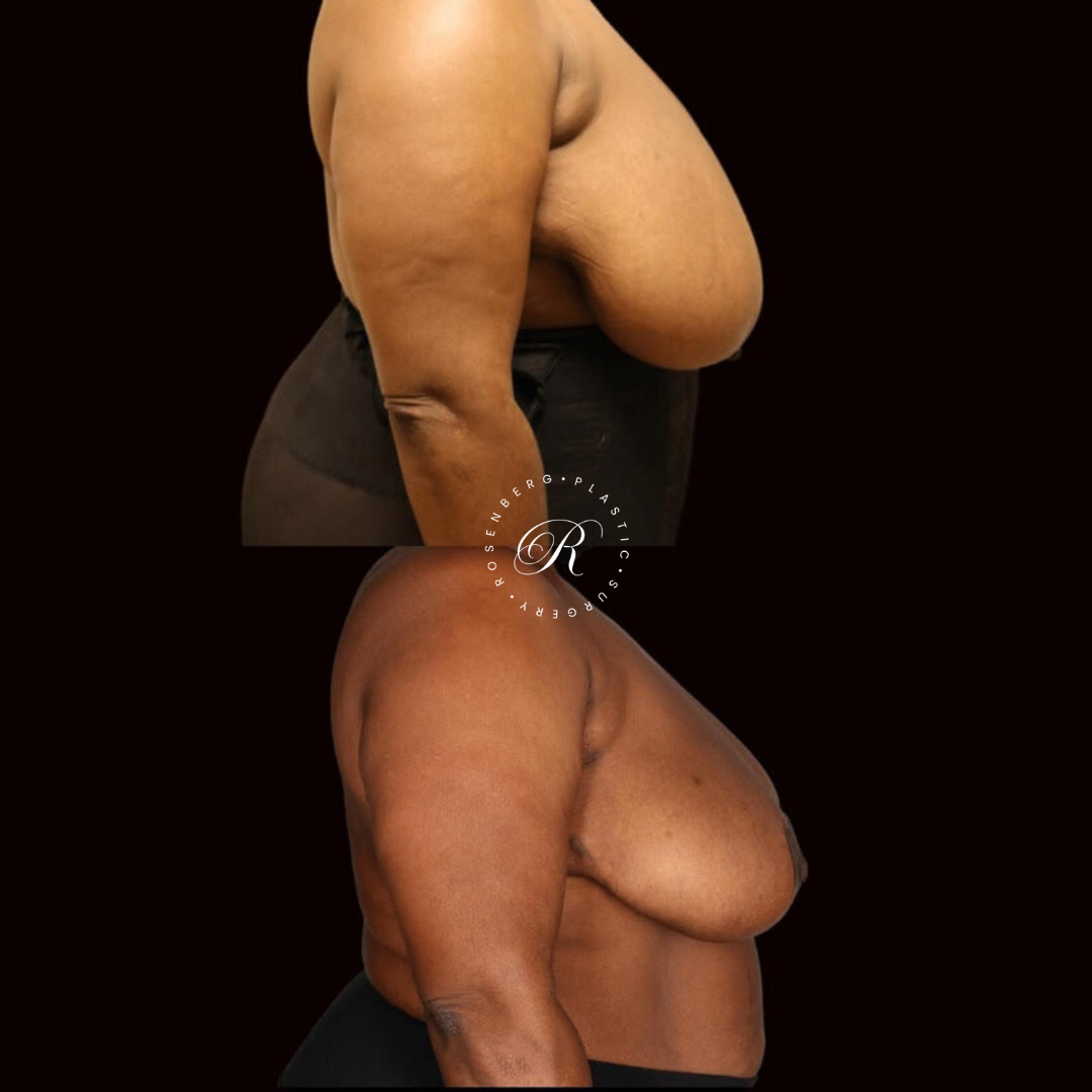 Breast Lift & Reduction RPS Before & Afters.zip - 11