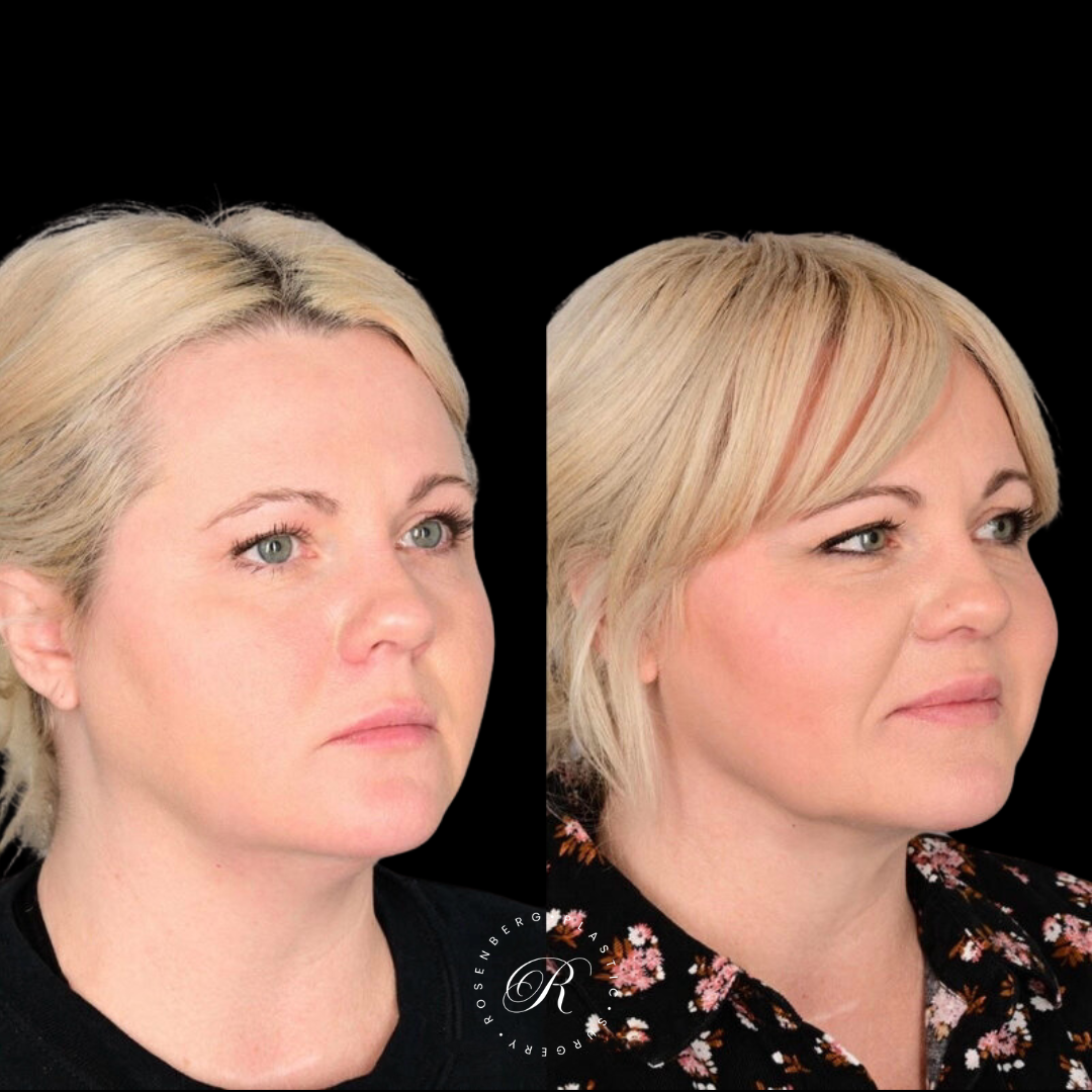 Neck Lipo RPS Before & After.zip - 22