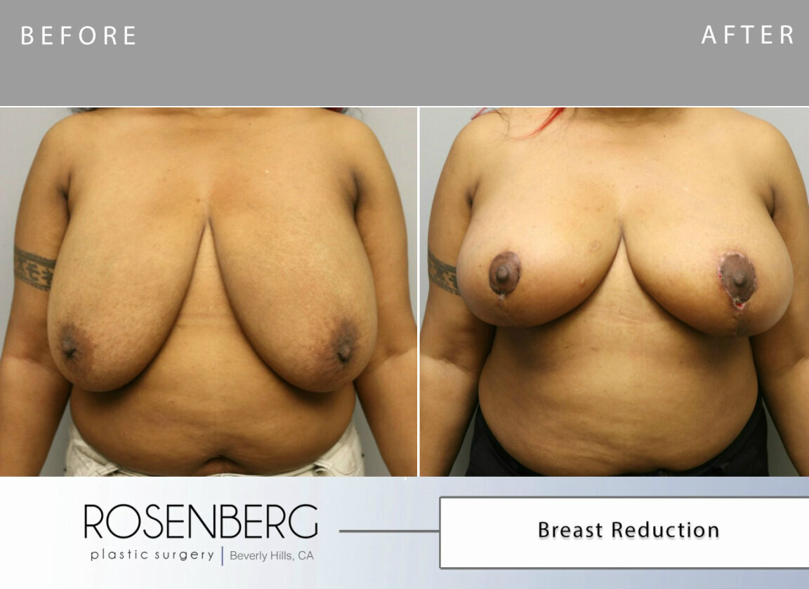 Shadonna Bailey Breast Reduction B&A 2