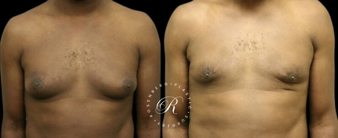 Gynecomastia RPS Before & Afters.zip - 5