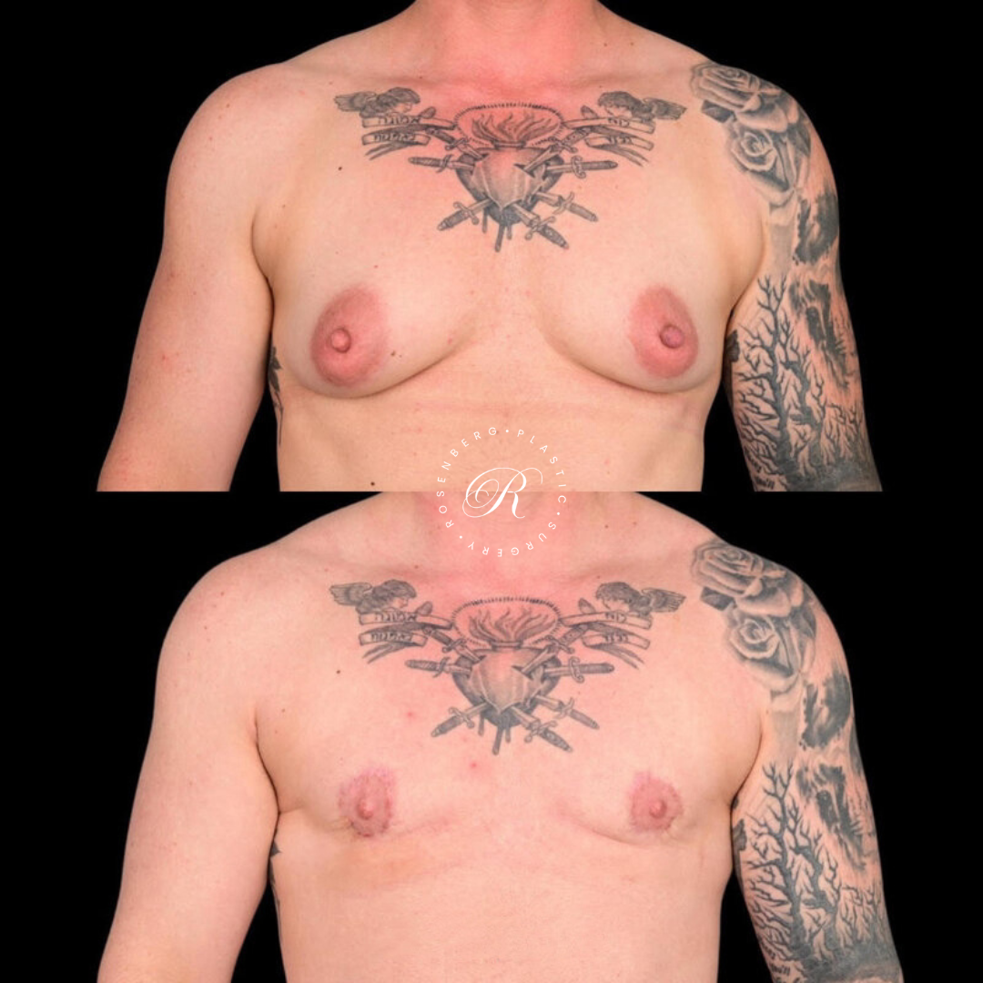 Top Surgery RPS Before & After.zip - 5