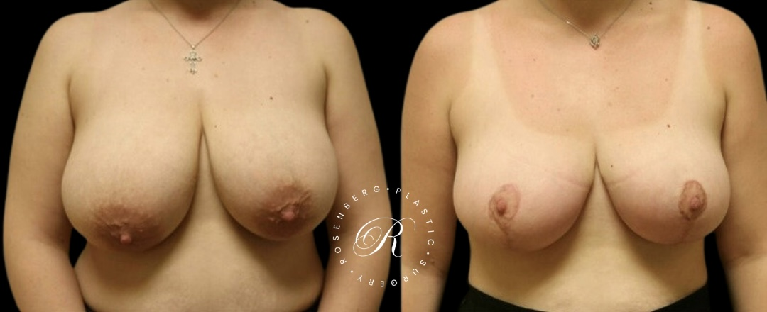 Breast Lift & Reduction RPS Before & Afters.zip - 95