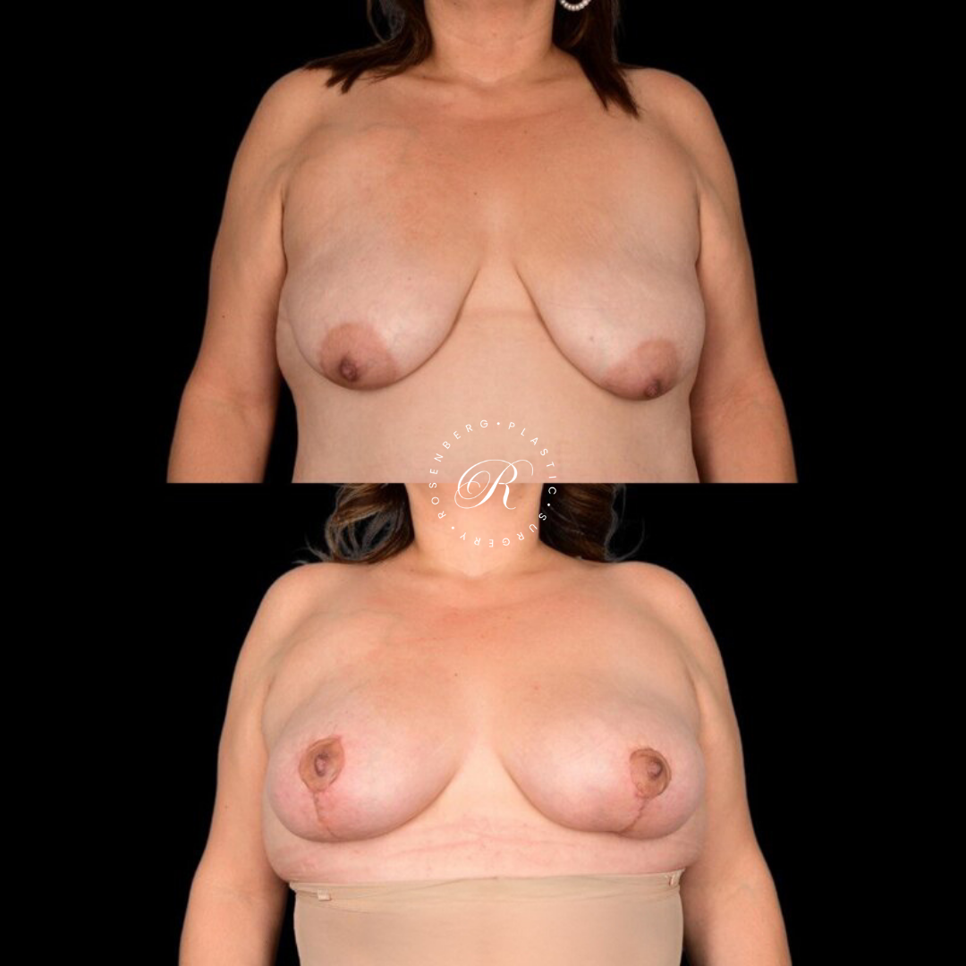 Breast Lift & Reduction RPS Before & Afters.zip - 47
