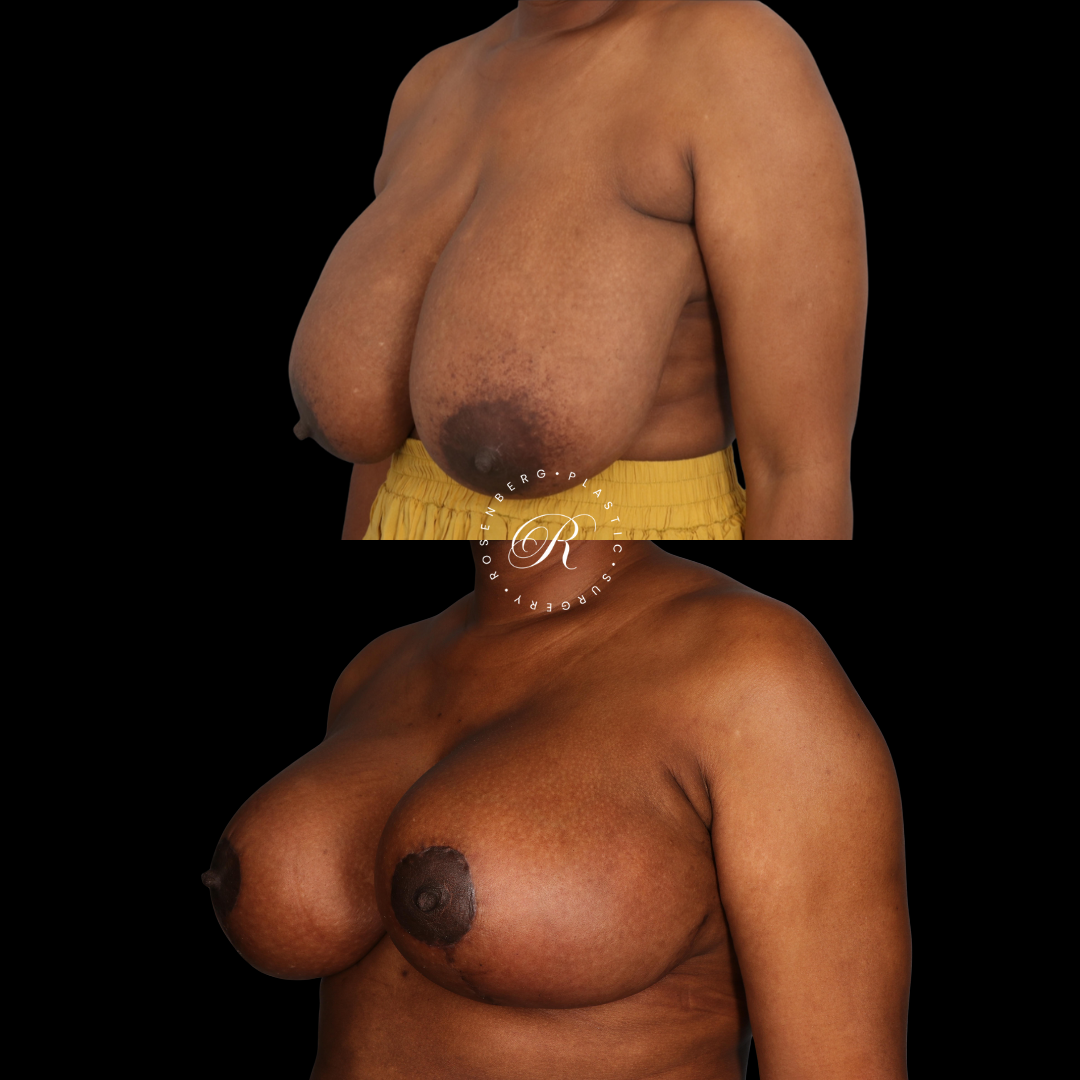 Breast Lift & Reduction RPS Before & Afters.zip - 3