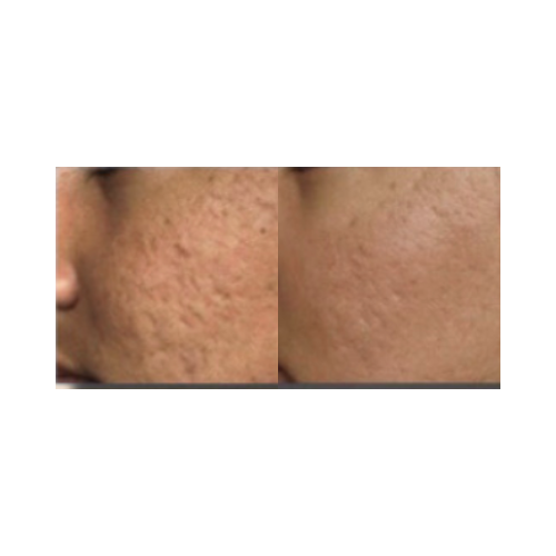 Improved skin elasticity and tone after DermalPen sessions