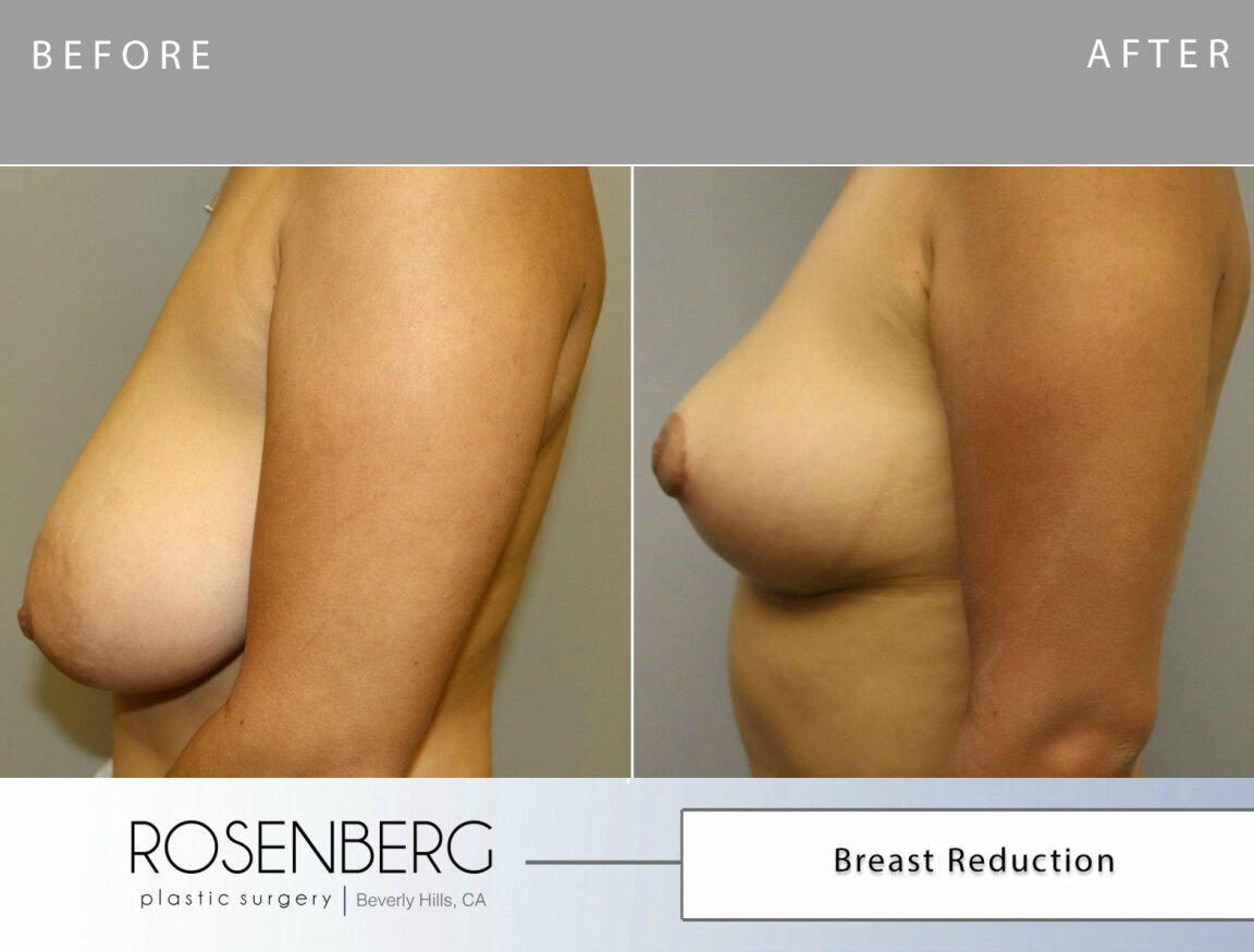 Kim Carney  Breast Reduction B&A side 1