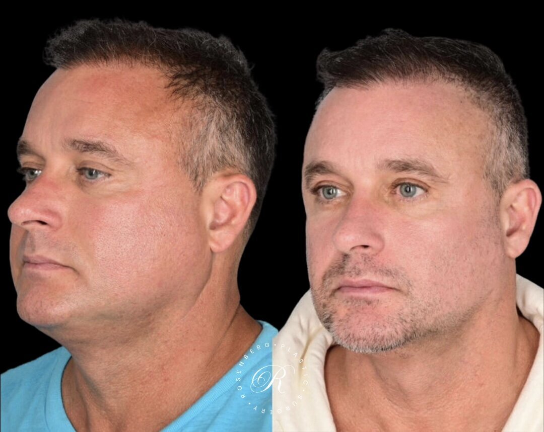 Buccal Fat Pad Removal RPS Before & After.zip - 1