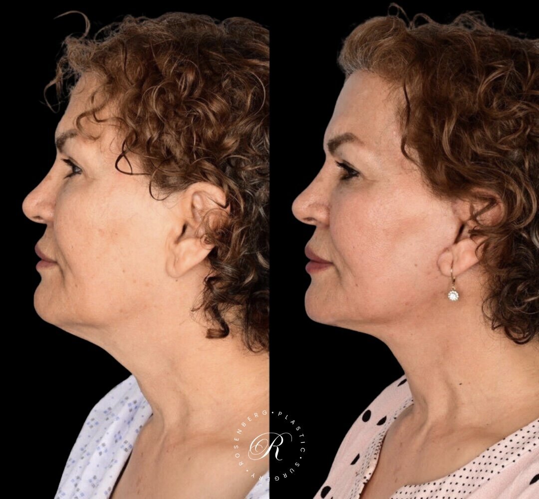 Facelift RPS Before & After.zip - 10