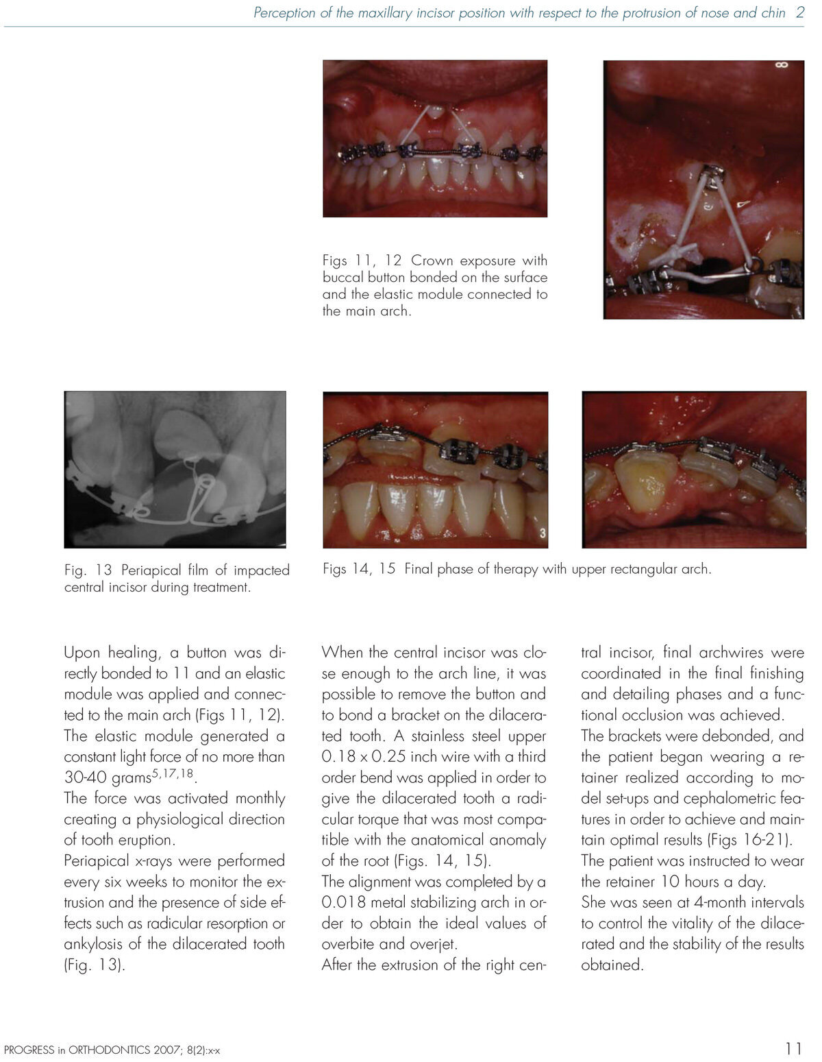 Dilacerated in adult-6