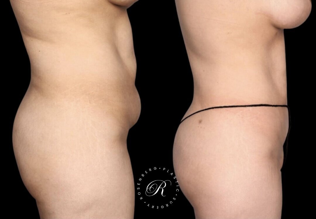 Liposuction of Abs, Back and Flanks RPS Before & After.zip - 2