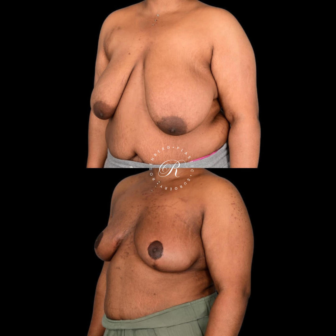 Breast Lift & Reduction RPS Before & Afters.zip - 32