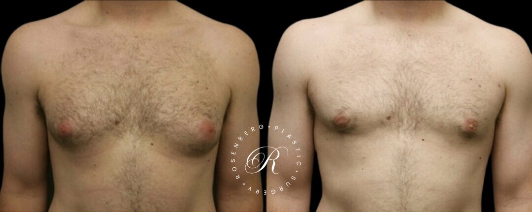 Gynecomastia RPS Before & Afters.zip - 7