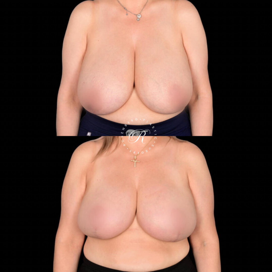 Breast Lift & Reduction RPS Before & Afters.zip - 29