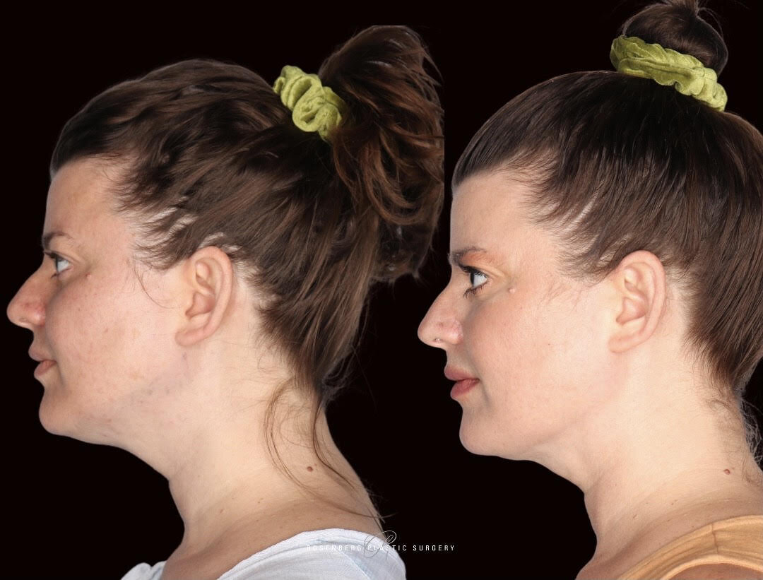 Neck Liposuction Results