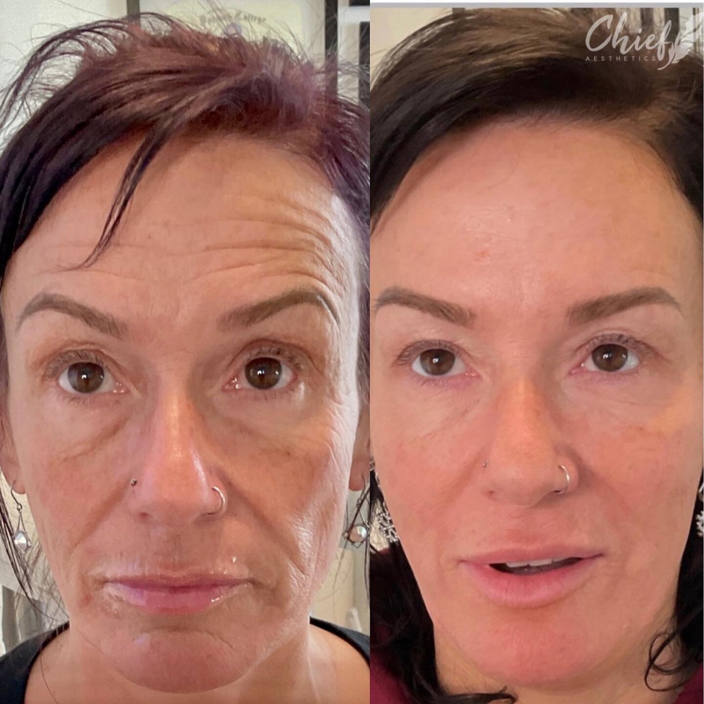 Xeomin-filler-and-skincare-chief-aesthetics-ny