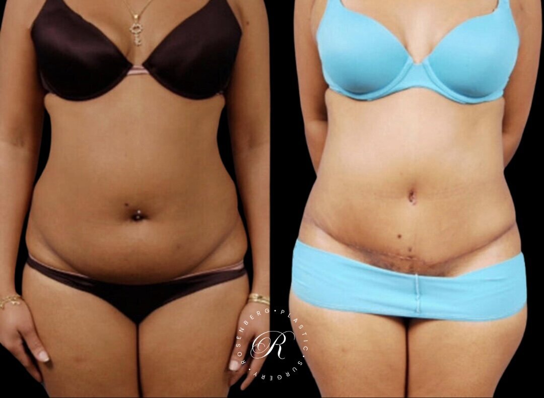 Abdominoplasty RPS Before & After.zip - 3