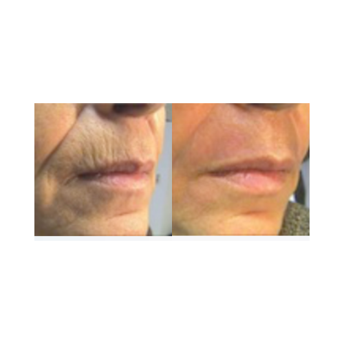 Skin texture improvement post UltraLight CO₂ laser treatment