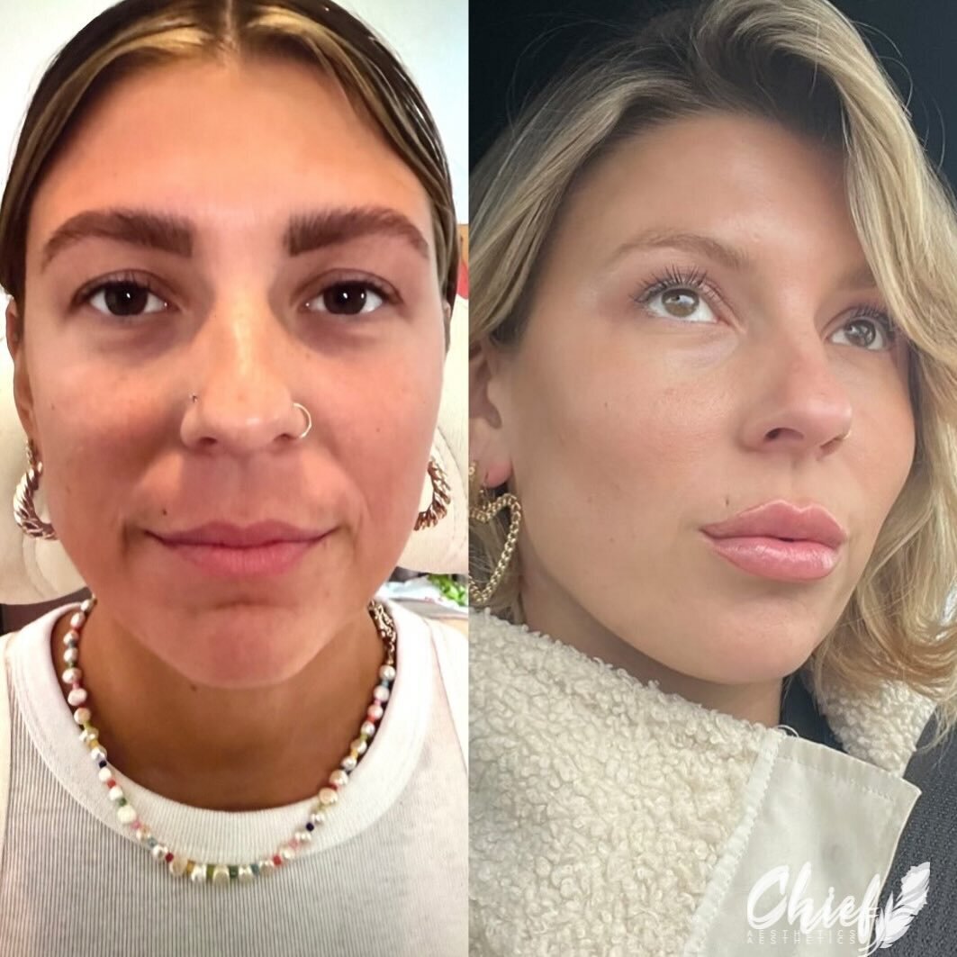 xeomin-antiwrinkle-rediesse-zo-skincare-before-after-regimen-by-chief-aesthetics-buffalo-ny