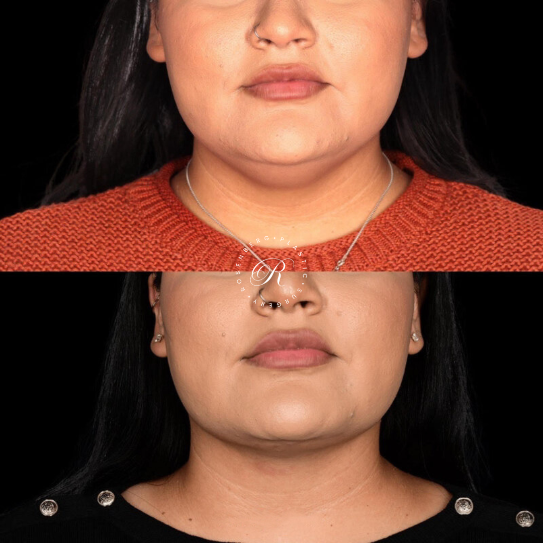 Neck Lipo RPS Before & After.zip - 27