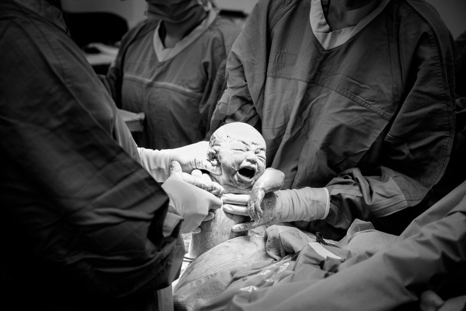 newborn baby just delivered by c-section