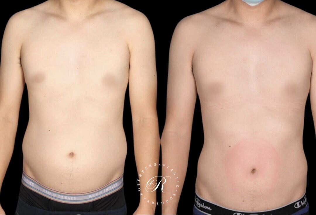 Liposuction of Abs, Back and Flanks RPS Before & After.zip - 7