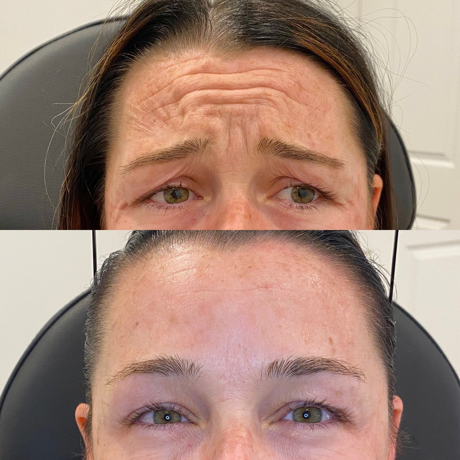canova-aesthetics-med-spa-before-after-injectables-2