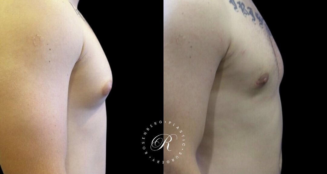Gynecomastia RPS Before & Afters.zip - 11
