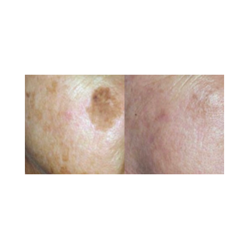 Improved skin elasticity and tone after DermalPen sessions