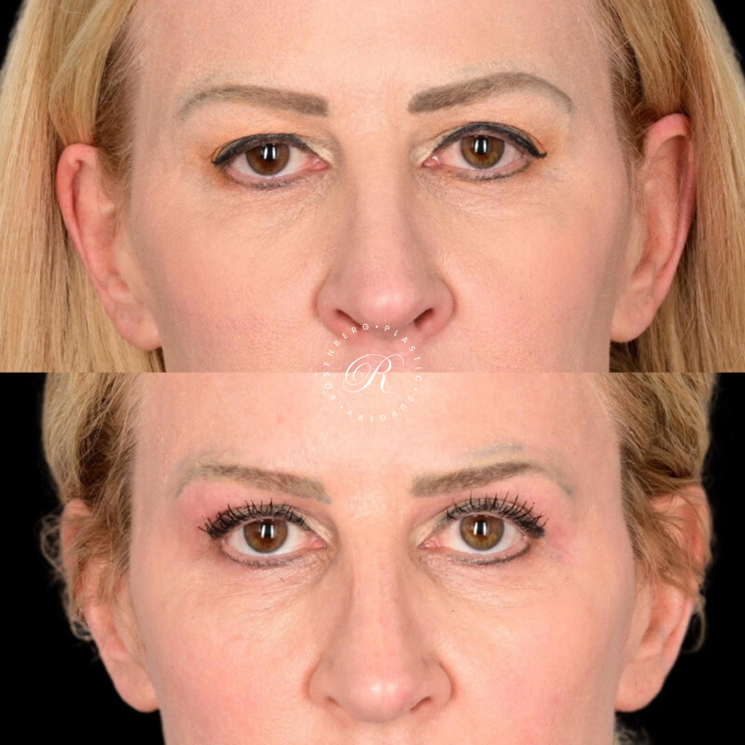 Blepharoplasty RPS Before & After.zip - 1