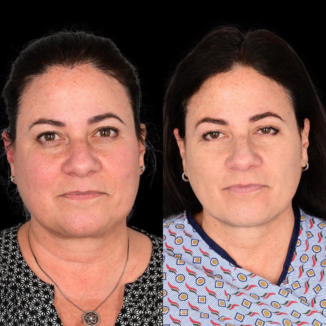 Neck Liposuction Results